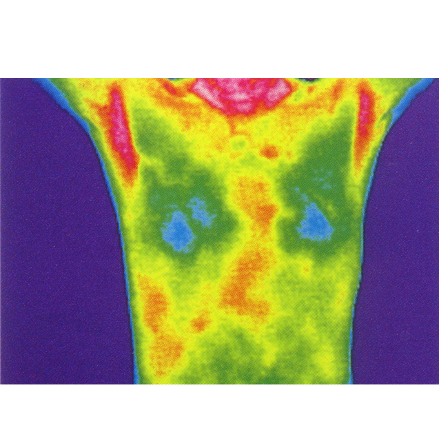   乳腺診斷

熱成像可以用來檢測乳房組織的溫度差異，由于腫瘤組織的新陳代謝通常高于正常組織，它們可能會在熱圖像上表現(xiàn)為熱斑。