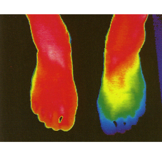   足部健康評估：

熱成像可以用來監(jiān)測糖尿病患者的足部溫度，預(yù)防足部并發(fā)癥，如潰瘍和感染。