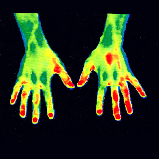   疼痛管理與康復(fù)評估：

熱成像用于監(jiān)測肌肉骨骼系統(tǒng)的健康狀況，如關(guān)節(jié)炎患者的關(guān)節(jié)熱力學(xué)變化、肌肉拉傷或損傷后愈合過程中的血流恢復(fù)情況等。